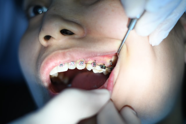 Eating and Getting Nutrients When Your Jaw Is Wired Shut