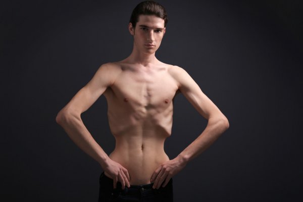 How Does Cystic Fibrosis Cause Malnutrition?