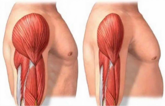 What Is the Difference Between Sarcopenia and Atrophy?